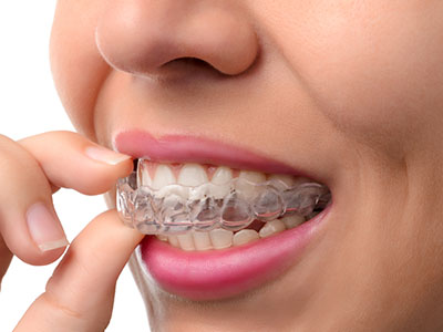 An individual is seen holding a transparent dental retainer, possibly for teeth alignment or orthodontic purposes.