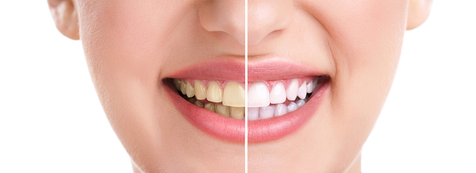 Before and after teeth whitening image featuring a smiling woman with noticeably brighter teeth.